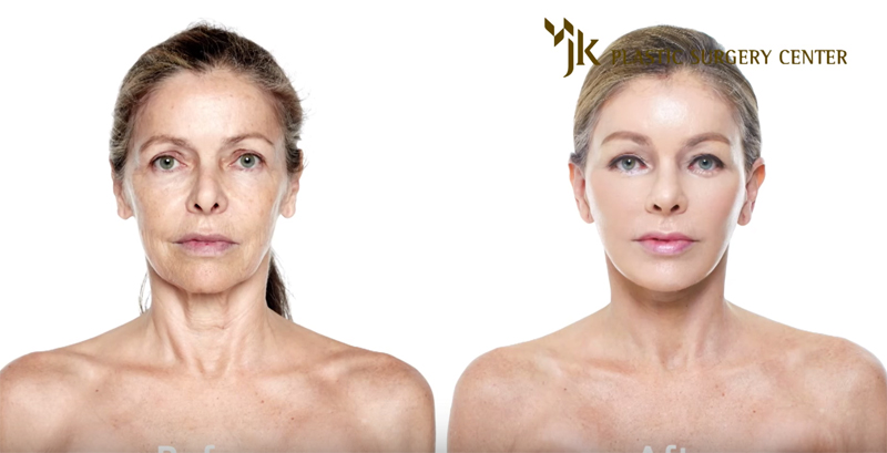 anti-aging treatment JK Plastic Surgery