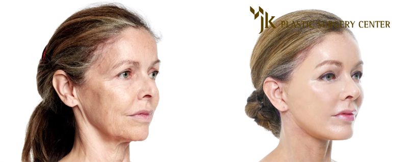 anti-aging treatment JK Plastic Surgery