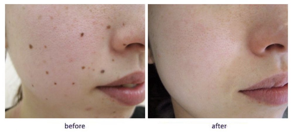 Facial Mole Removal Cost 21