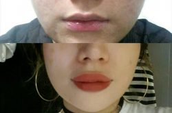My Lip Surgery at Deesse Plastic Surgery (Cheongdam Godess)